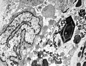 M,15y. | eosinophilic granuloma - Charcot- Leyden crystals